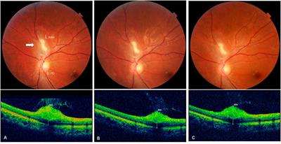 Long-term efficacy and safety of sirolimus for retinal astrocytic hamartoma associated with tuberous sclerosis complex